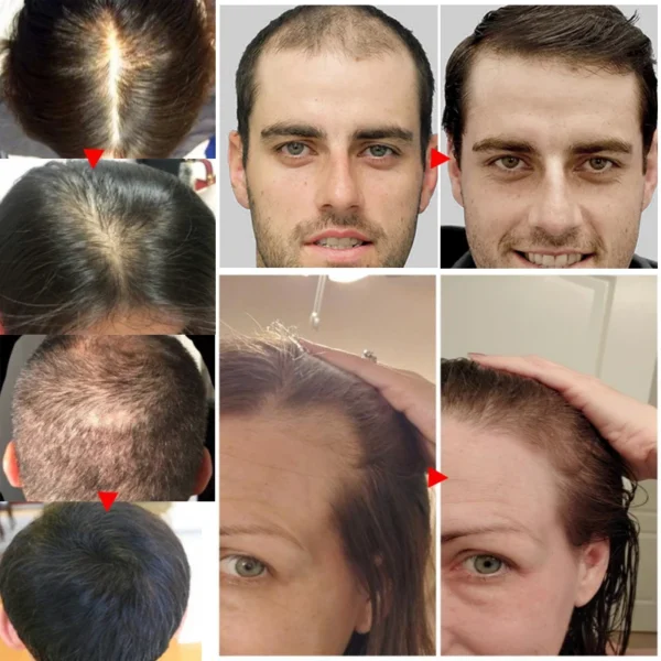 Serum Anti Hair loss- Treatment For Women Men - Image 3